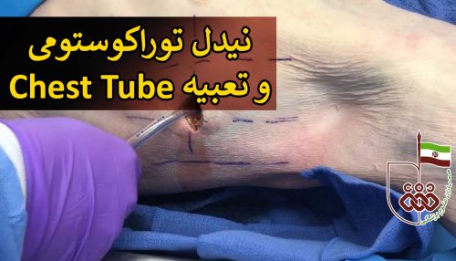 نیدل توراکوستومی، و تعبیه Chest Tube
